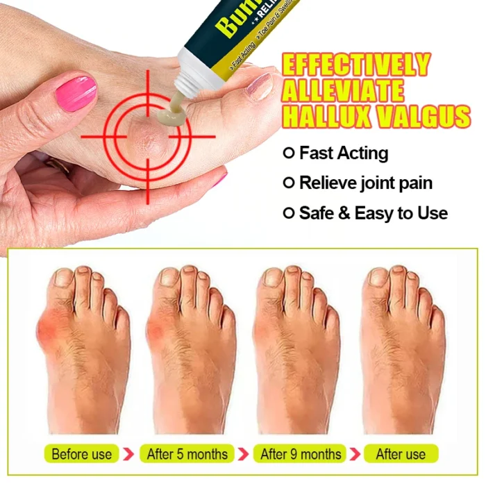 1Pcs Bunion Gout Pain Relief Ointment Toe Joint Pain Hallux Valgus Corrector Knee Lumbar Back Pain Treatment Herbal Cream G049 - Image 4